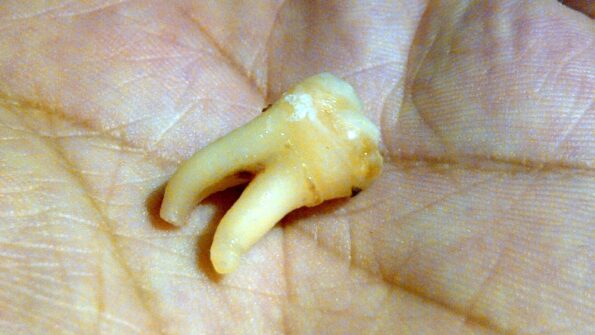 Wisdom tooth extracted - root canal treatment risks